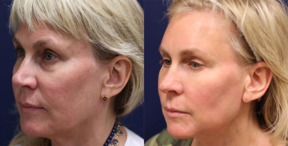 Non Surgical Facial Rejuvenation Before and After Photo by Rejuvalife Vitality Institute in Los Angeles