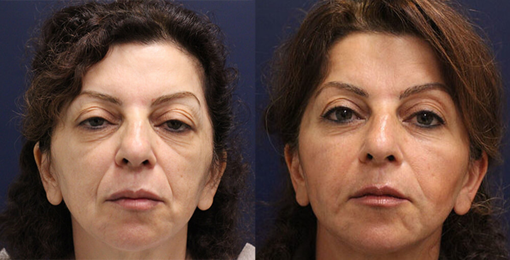Facial Fat Transfer Before and After Photo by Rejuvalife Vitality Institute in Los Angeles