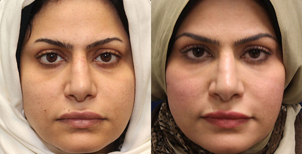 Facial Fat Transfer Before and After Photo by Rejuvalife Vitality Institute in Los Angeles