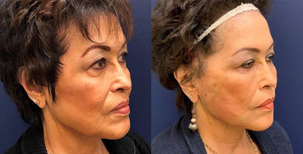 Mint Threadlift PDO Treatment Before and After Photo by Rejuvalife Vitality Institute in Los Angeles