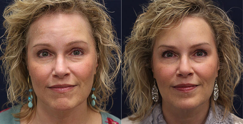 Bellafill Before and After Photo by Rejuvalife Vitality Institute in Los Angeles