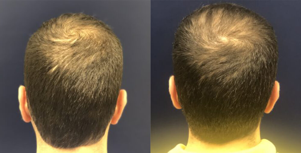 PRP for Hair Loss Before and After Photo by Rejuvalife Vitality Institute in Los Angeles