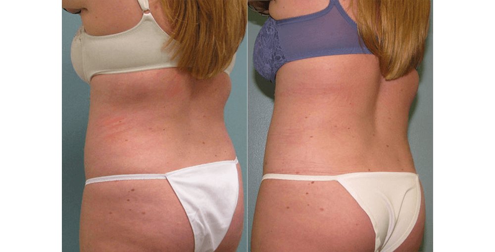 Body Sculpting (Arms / Legs) Before and After Photo by Rejuvalife Vitality Institute in Los Angeles