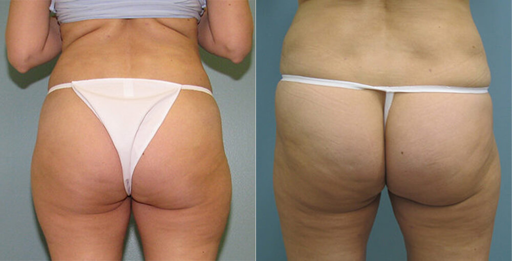 Body Sculpting (Arms / Legs) Before and After Photo by Rejuvalife Vitality Institute in Los Angeles