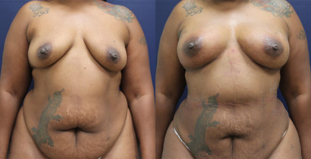 Natural Breast Augmentation Before and After Photo by Rejuvalife Vitality Institute in Los Angeles