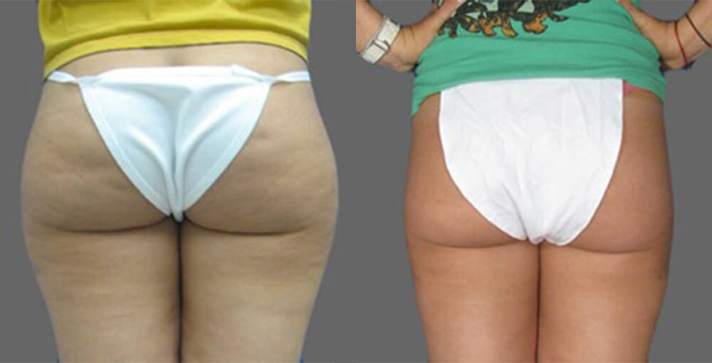 Cellulite Reduction & Cellulaze Before and After Photo by Rejuvalife Vitality Institute in Los Angeles