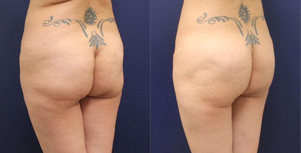 Silhouette Buttlift with Threads Before and After Photo by Rejuvalife Vitality Institute in Los Angeles